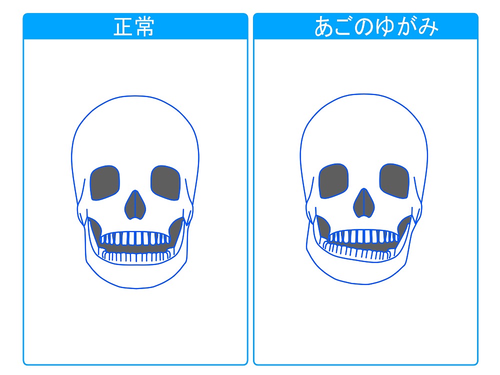 顎関節症とは