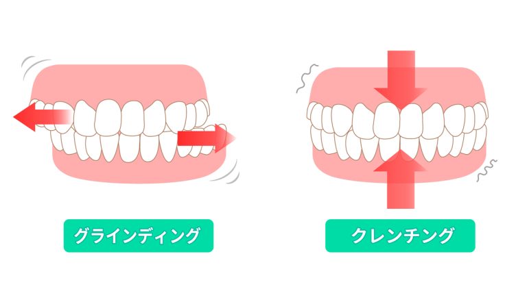 歯ぎしり・食いしばり