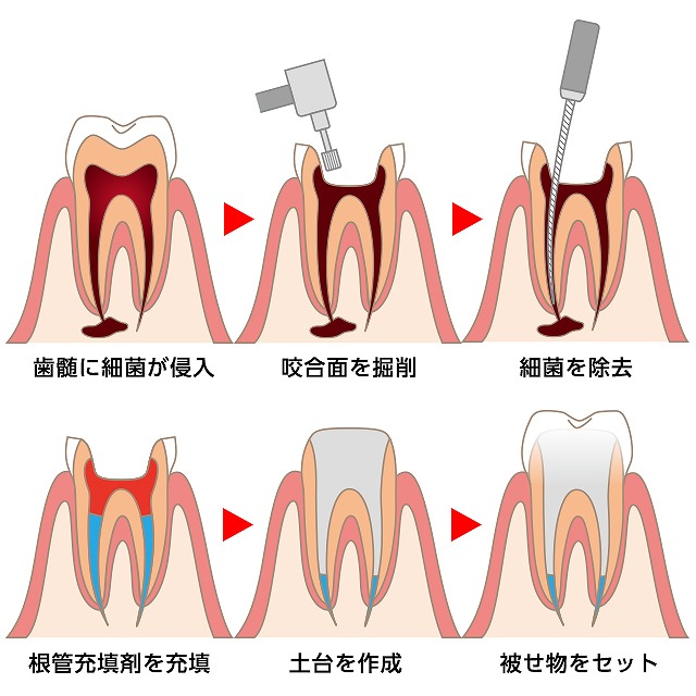 根管治療の流れ