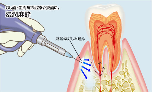 電動麻酔