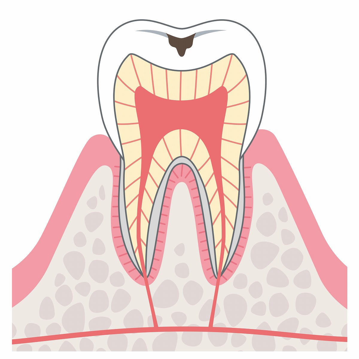 C1（初期の虫歯）