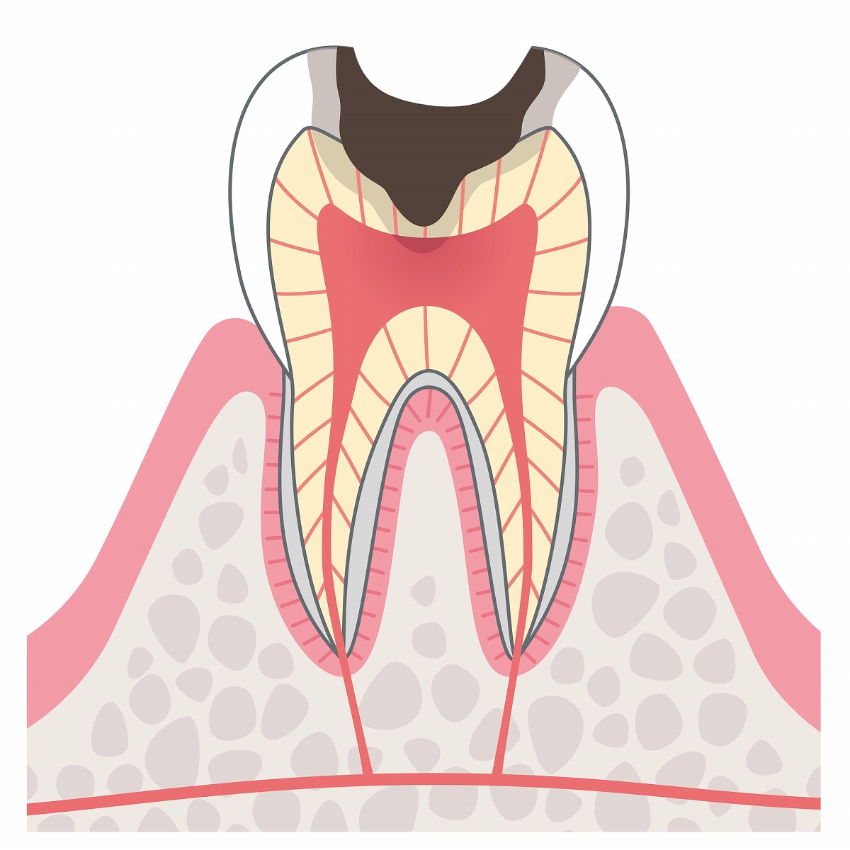 C3（後期の虫歯）